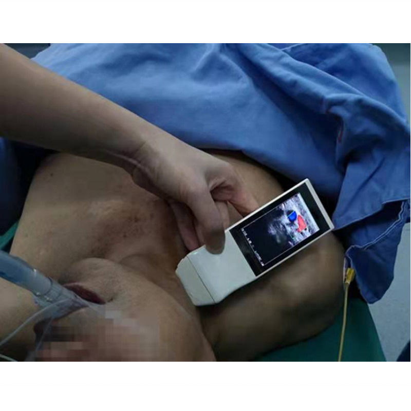 WIFI Wireless Color Probe GYN Ultrasuoni Probe lineare con display Anestesia Punzione Navigazione Ultrasuoni portatili